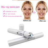 Therapy Acne Laser Pen Soft Scar Wrinkle Removal Treatment InformationEssentials